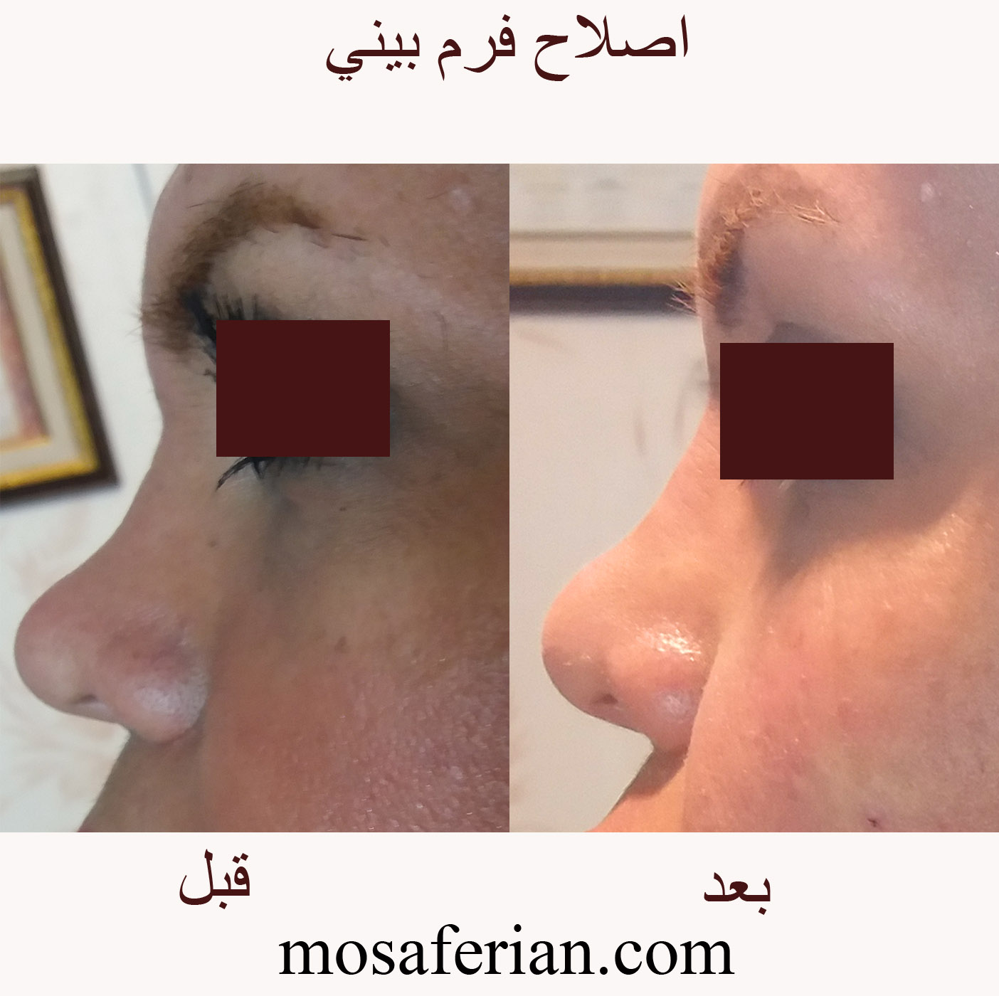 Non surgical nose job before and after