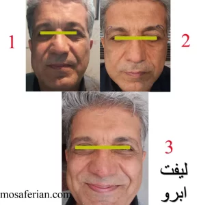 Direct brow lift scars