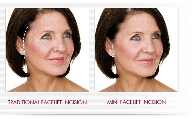 Mini facelift before and after