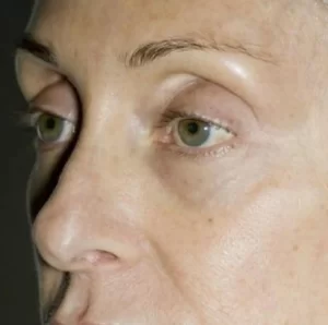 Sunken eyes after surgery