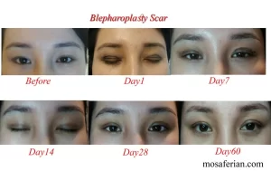 asian blepharoplasty recovery stages