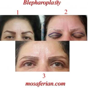 eyelid lift before and after