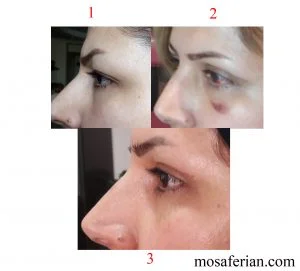 subconjunctival hemorrhage and blepharoplasty scars