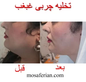 double chin lipo