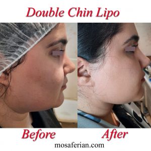 double chin lipo