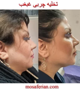 Double chin before and after