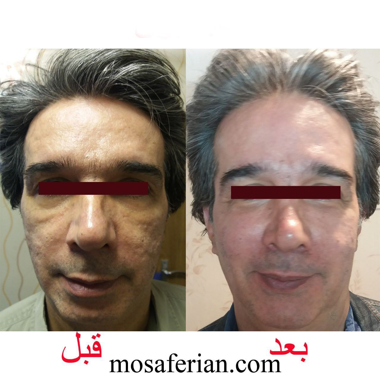 Nanofat for acne scar