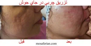 nanofat for acne scars before and after