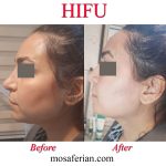 Hifu treatment before and after
