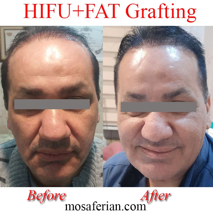 Ultherapy after Fat grafting enhance the results