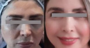 skin chemical peel before and after