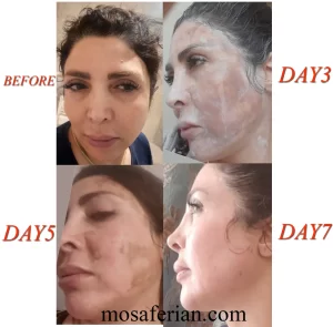 chemical peeling recovery day by day