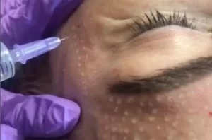 Mesotherapy under the eyes