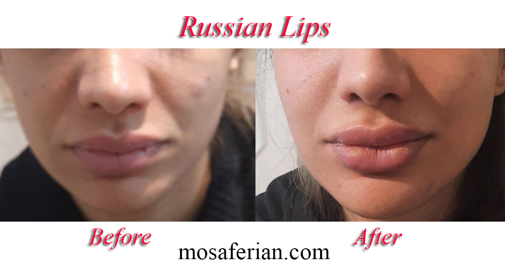 Russian Lip Filler Before And After💋