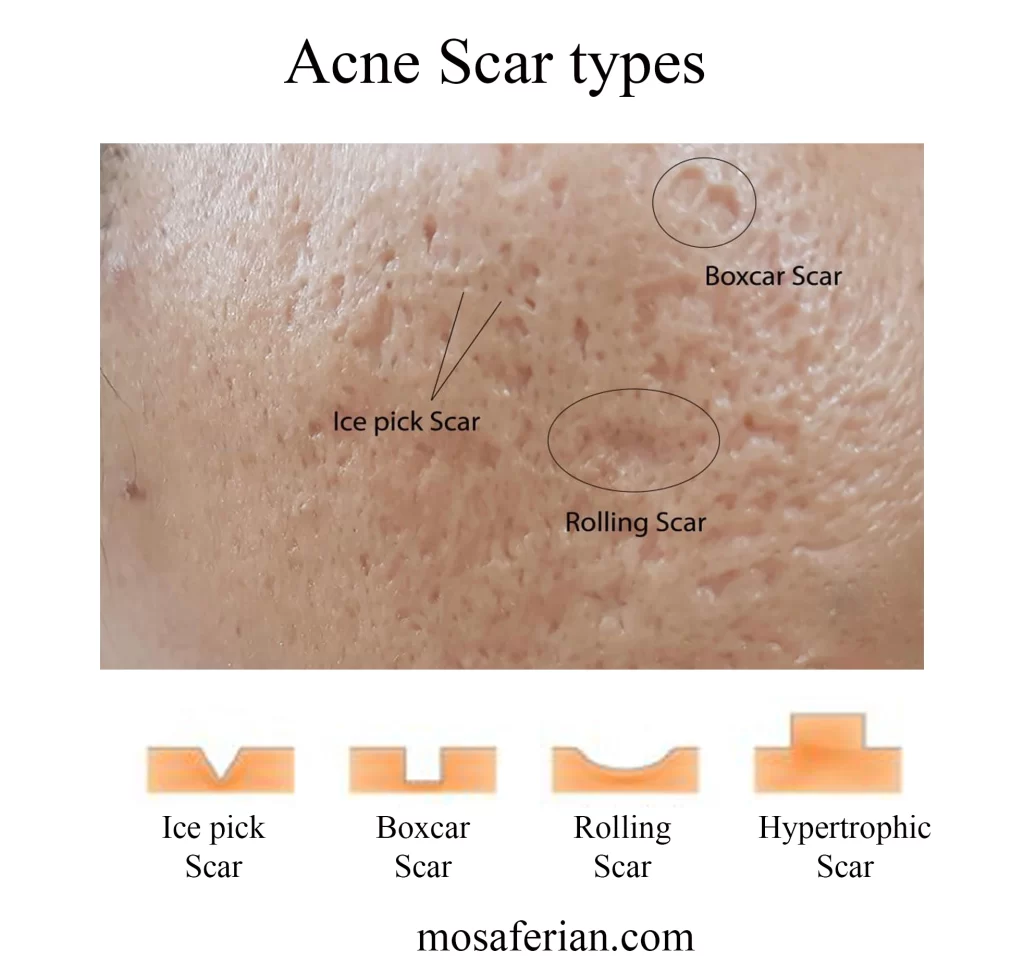 acne scar types