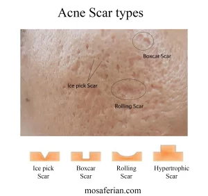 acne scar types