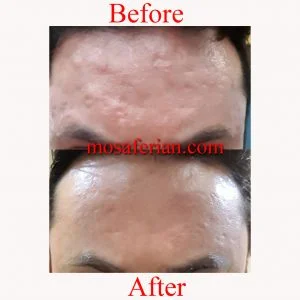 forehead scar treatment before and after