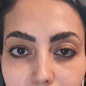 left eye ptosis after botox injection