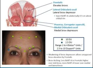 forehead anatomy and  standard botox injection points