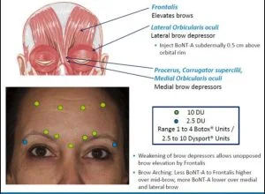 botox side effects