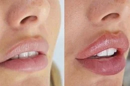 russian lip filler before and after