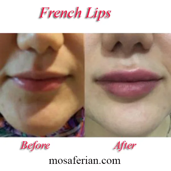 lip filler french style