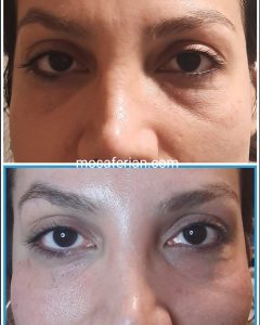 Under eye filler before and after