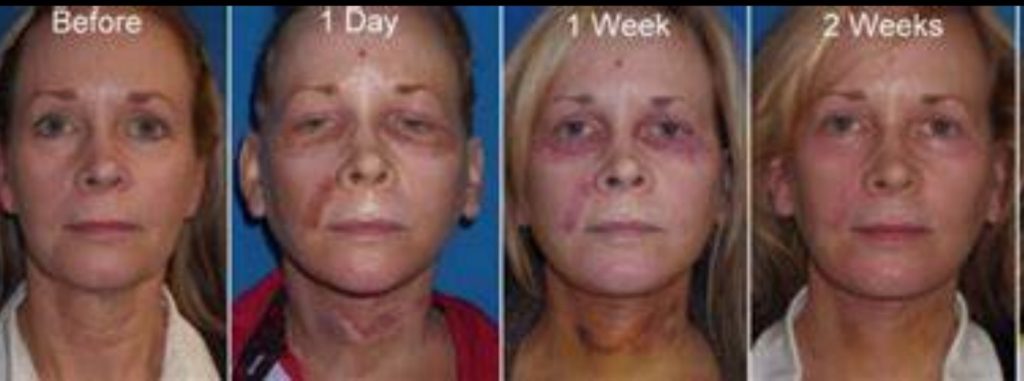 lower blepharoplasty recovery photos day by day