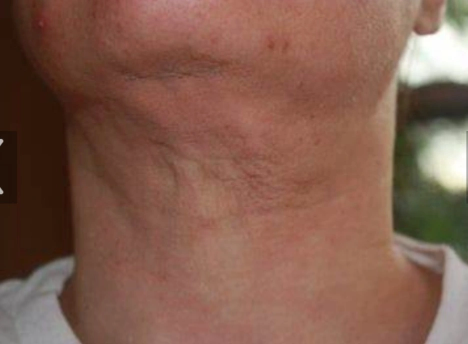 chin lipo scar due to aggressive liposuction