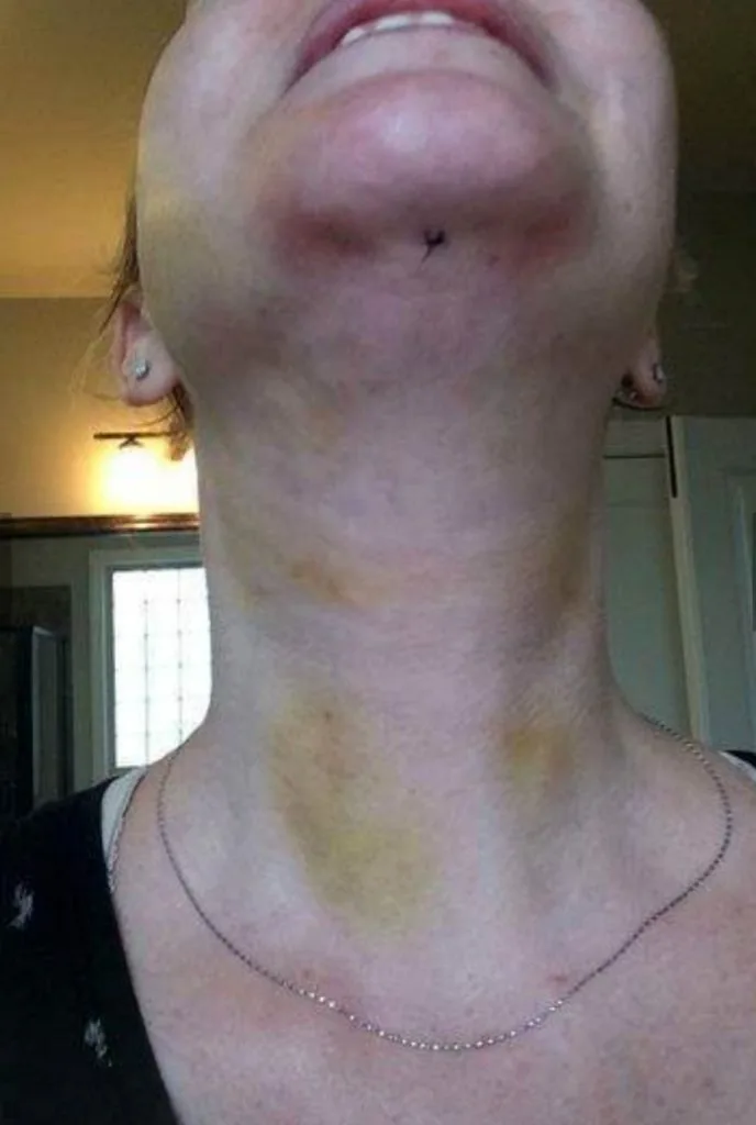 Neck scar after liposuction