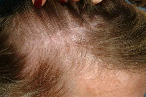 Hair loss after  endoscopic brow lift 