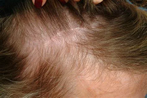 Hair loss after endoscopic brow lift