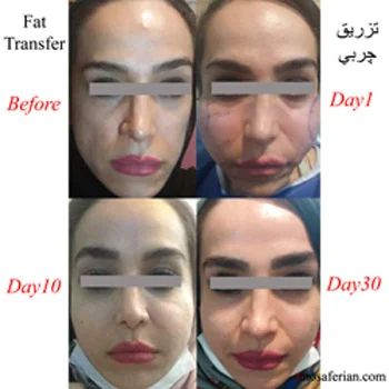 day by day fat transfer to face recovery time