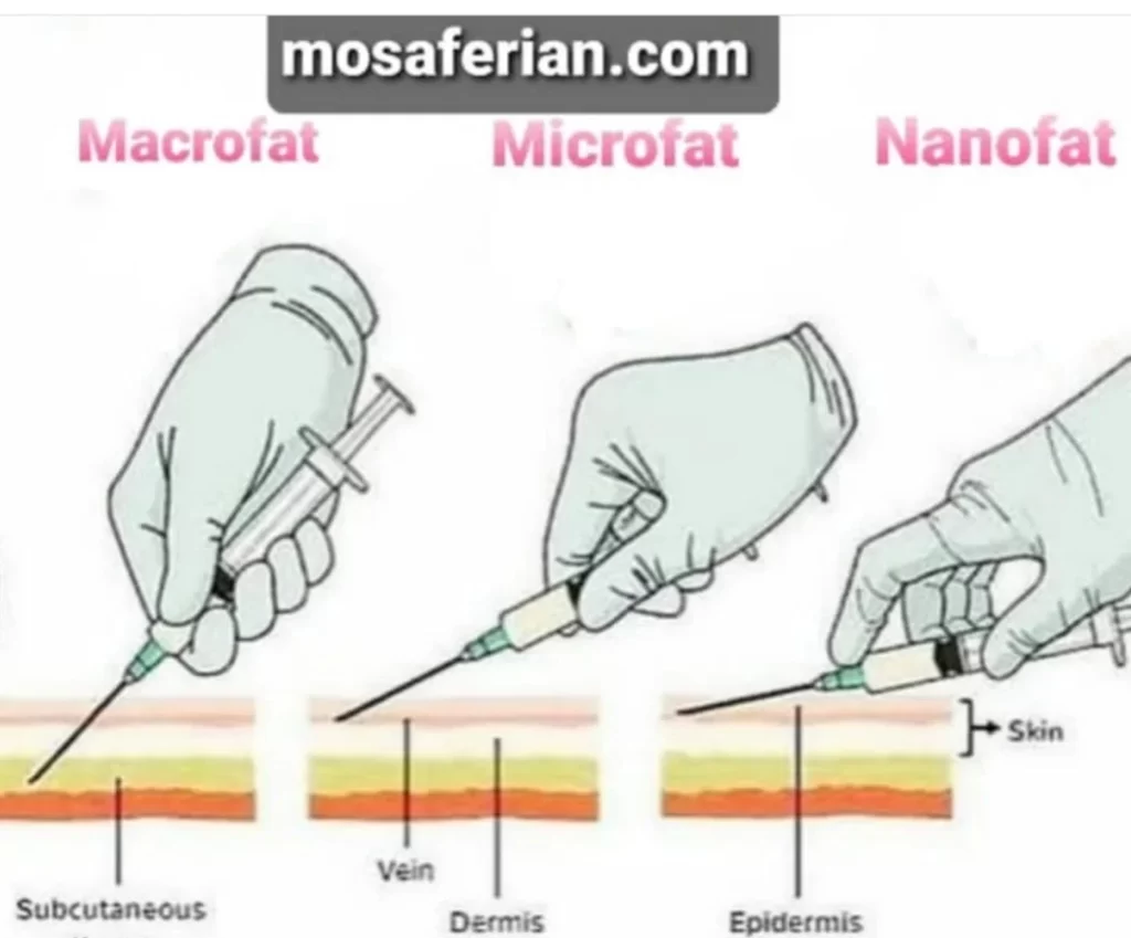 Macrofat  and microfat could transfer to the deepest tissue depth as well as periostium with blunt tipped cannula, however nanofat could apply to most superficial skin layer with sharp needle technique.