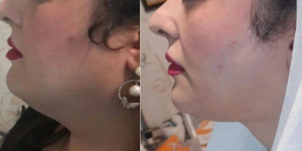 how to lose face fat in 24 hours