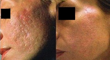 Punch excision for acne scars