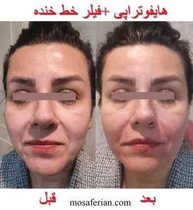 درمان ترکیبی هایفو و تزریق خط خنده