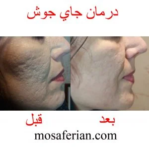 تصویر قبل و بعد در صورت یک خانم جوان با روش درمان ترکیبی