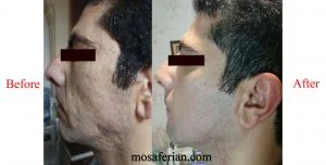 قبل و بعد درمان جای جوش در صورت یک مرد جوان با روش درمان ترکیبی
