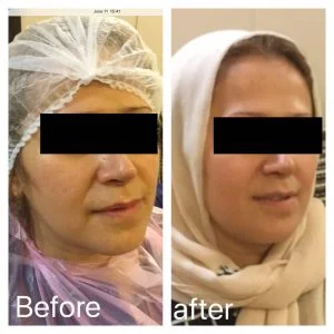 قبل و بعد سفت شدن پوست صورت و گردن در یک خانم جوان با روش آر اف