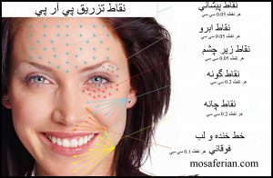 أماكن حقن البلازما في الوجه