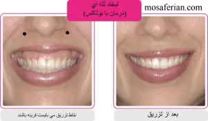 قبل و بعد درمان لبخند لثه ای با بوتاکس