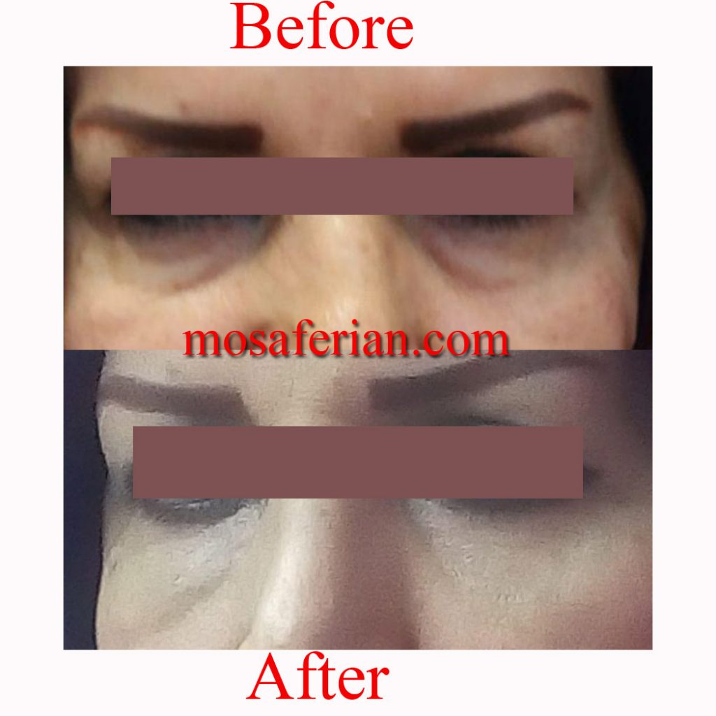 درمان پف زیر چشم قبل و بعد