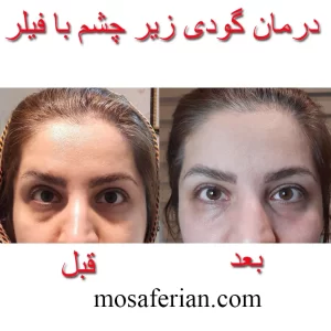 درمان خط زیر چشم قبل و بعد