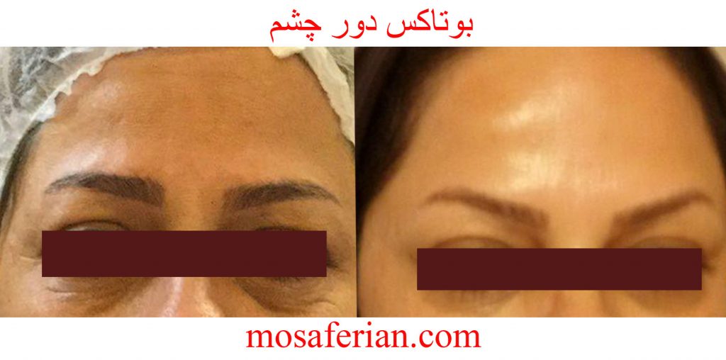 حقن البوتوکس