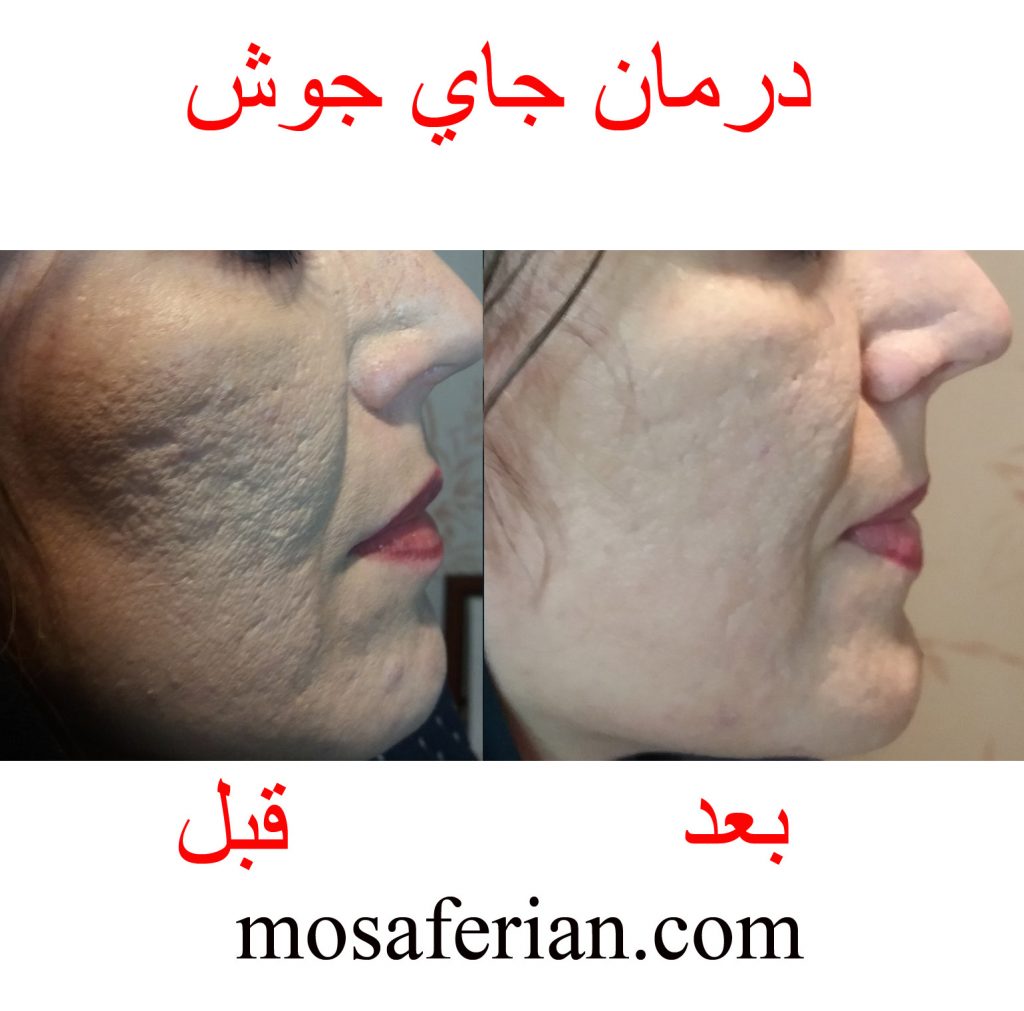 عکس قبل و بعد از لیزر جای جوش