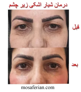 درمان شیار اشکی زیر چشم قبل و بعد