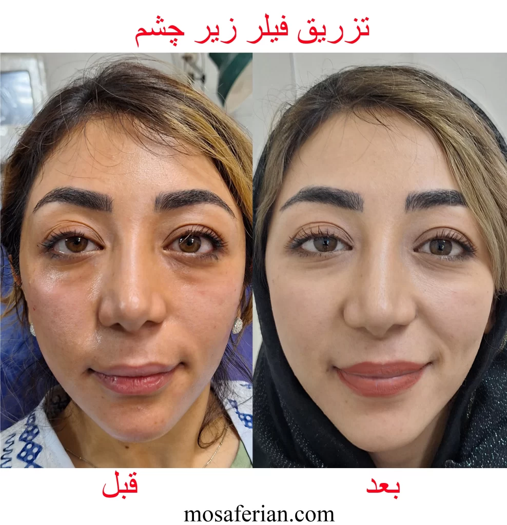 تزریق ژل زیر چشم قبل و بعد