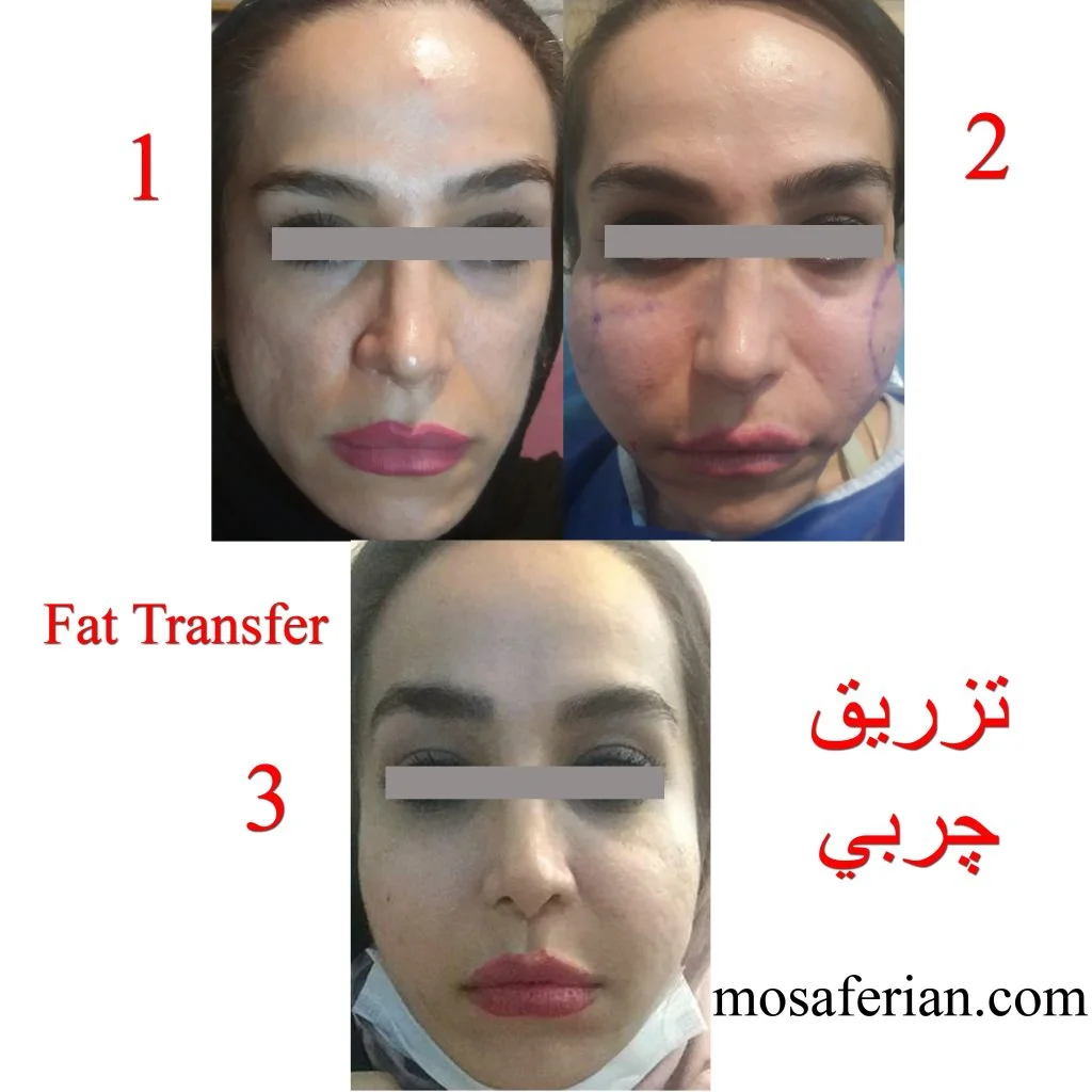 تورم بعد از تزریق چربی ظرف یک هفته برطرف می شود