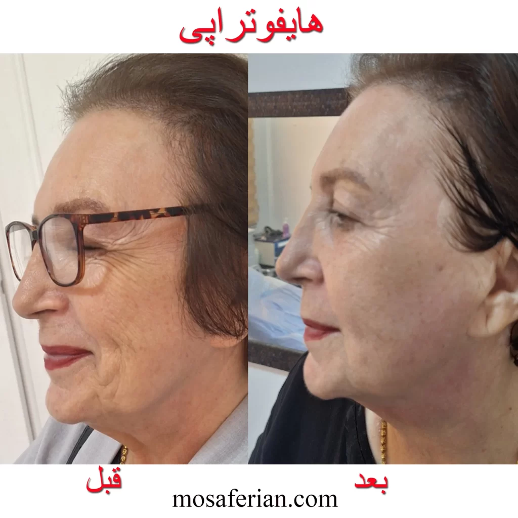 هایفوتراپی دور چشم قبل و بعد